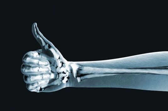 Rentgen k diagnostice bolesti v kloubech prstů