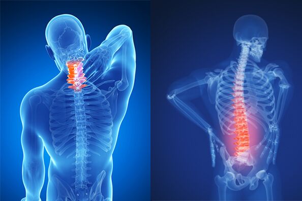 Osteochondróza krční a bederní páteře