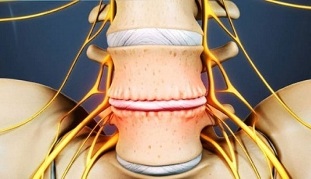 hlavní příznaky cervikální osteochondrózy